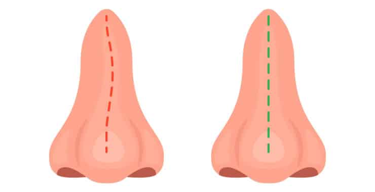 Desvio de septo volta? Entenda como funciona a septoplastia